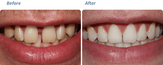 Before and after Invisalign result 1