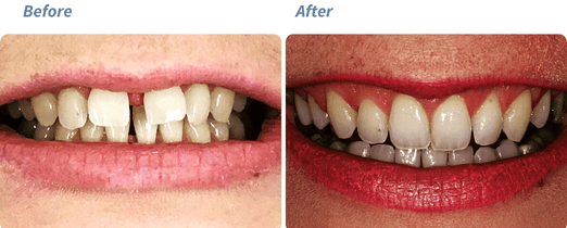 Before and after Invisalign result 4