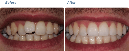 Before and after Invisalign result 2