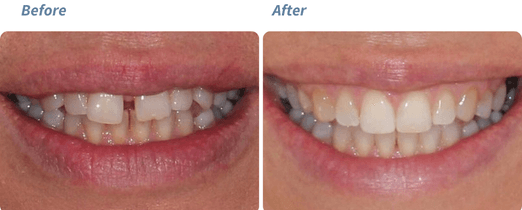 Before and after Invisalign result 3